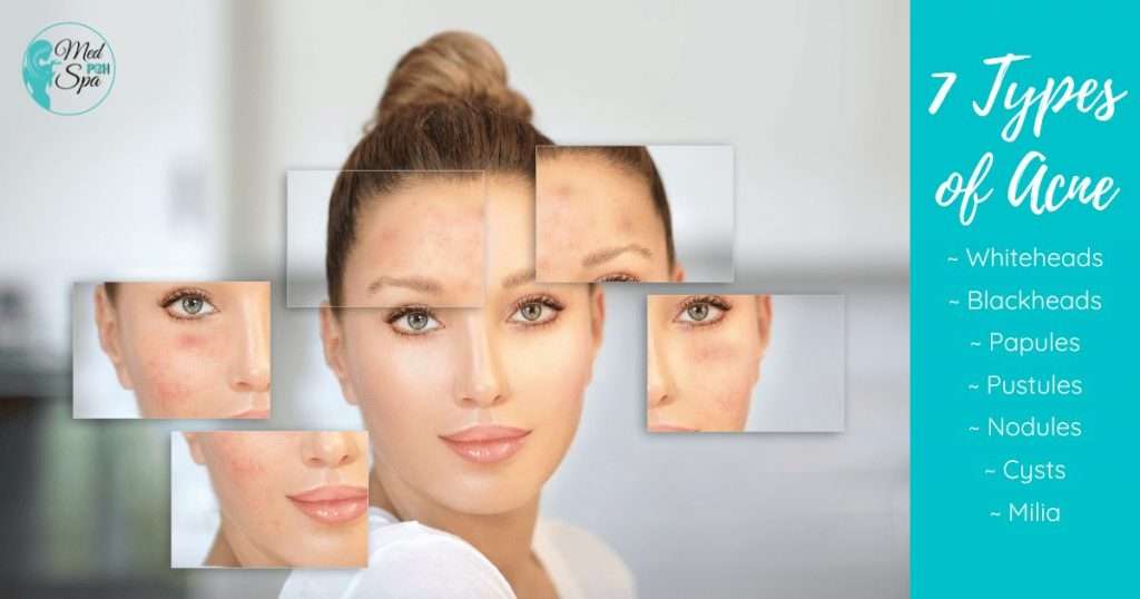 Acne Treatments near me-Pittsburgh