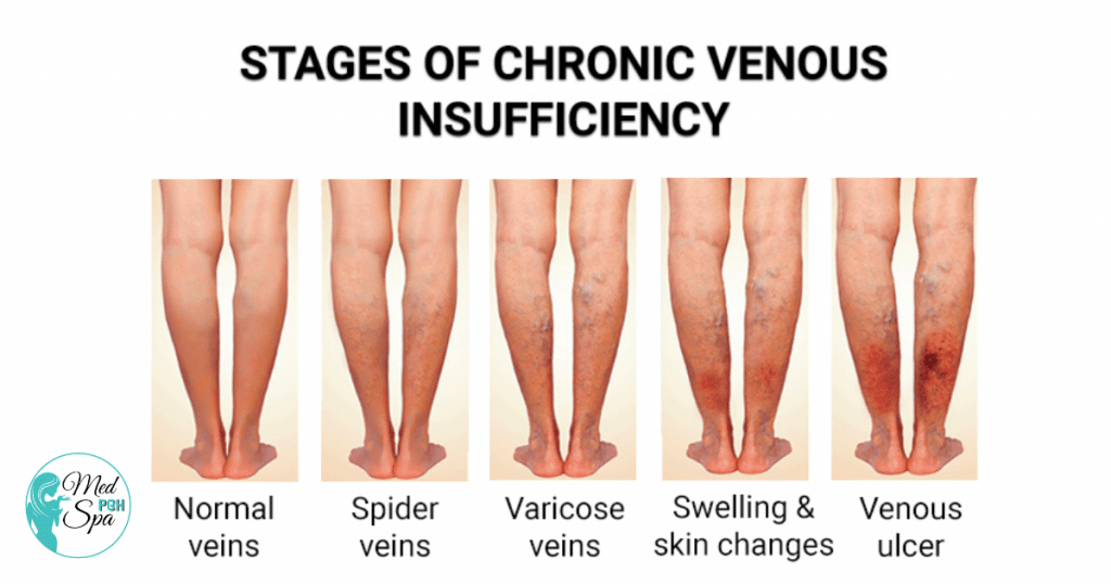 Varicose veins treatments Monroeville, PA, pittsburgh